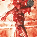Suction Abortion