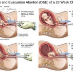 partial_birth_diagram